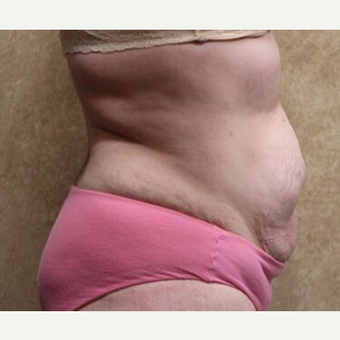 Tummy Tuck with Liposuction before 3454664