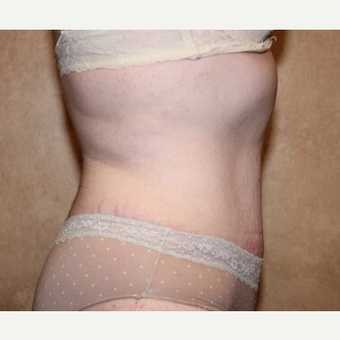 Tummy Tuck with Liposuction after 3454664
