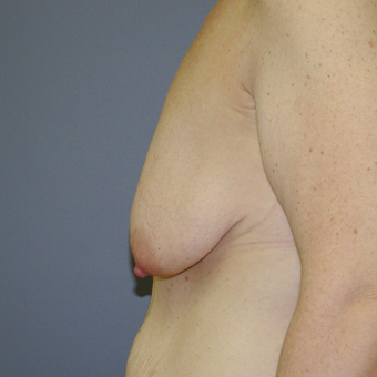 41 year old woman treated with Breast Lift before 3042796
