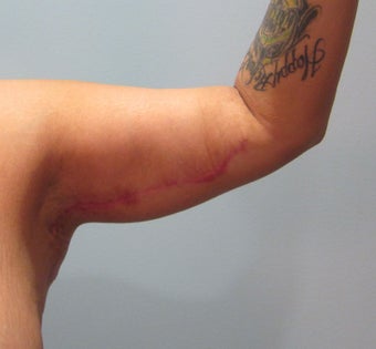 29-year-old female following massive weight loss underwent arm lift or brachioplasty procedure after 729034