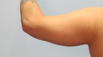 29-year-old female following massive weight loss underwent arm lift or brachioplasty procedure 729034