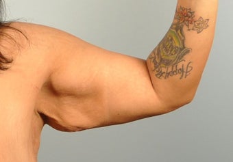 29-year-old female following massive weight loss underwent arm lift or brachioplasty procedure before 729034