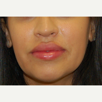 25-34 year old woman treated with Lip Augmentation after 3300204