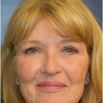 65-74 year old woman treated with Eyelid Retraction Repair after 2820456