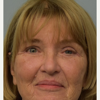 65-74 year old woman treated with Eyelid Retraction Repair before 2820456