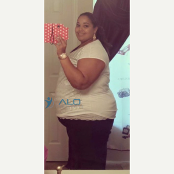 Gastric bypass results before 2452387