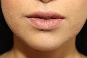 Injectable Fillers & Lip Augmentation before 1076893