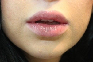 Injectable Fillers & Lip Augmentation after 1076893