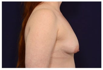 Breast Implants before 1422106