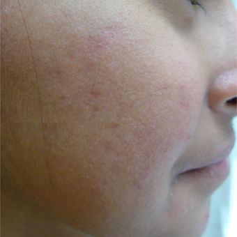 Acne treatments can take time... after 3719726