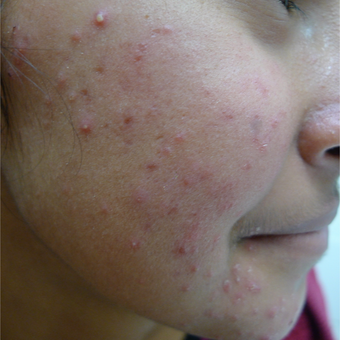 Acne treatments can take time... before 3719726