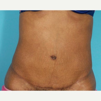 35-44 year old woman treated with Painless/Drainless Tummy Tuck after 2279119