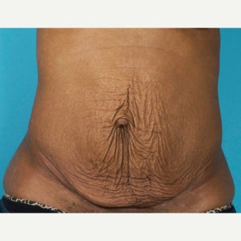 35-44 year old woman treated with Painless/Drainless Tummy Tuck before 2279119