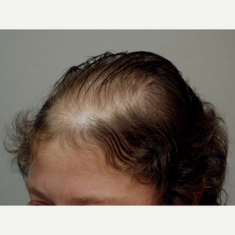 Hair Transplant before 3241458