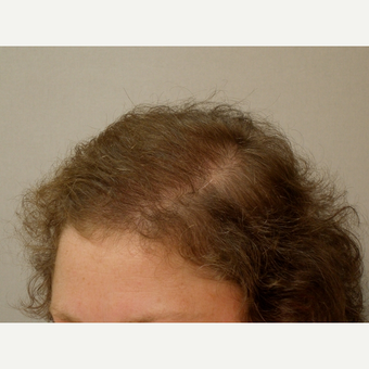 Hair Transplant after 3241458