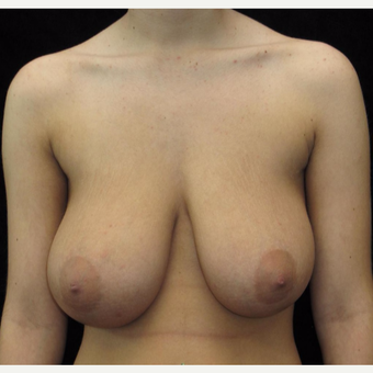 18 year old woman treated with Breast Reduction before 3026017