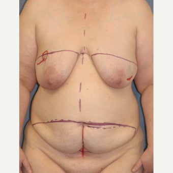 45-54 year old woman treated with Breast Reconstruction before 1835942