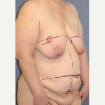 45-54 year old woman treated with Breast Reconstruction 1835942