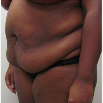 Tummy Tuck for This 39 Year Old African American Woman before 3387391