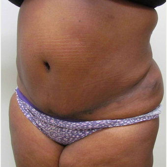 Tummy Tuck for This 39 Year Old African American Woman after 3387391