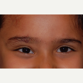 17 or under year old woman treated with Eyelid Surgery after 3625159