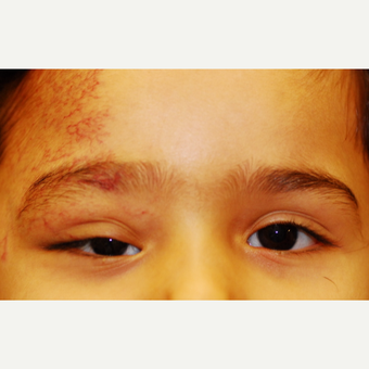 17 or under year old woman treated with Eyelid Surgery before 3625159