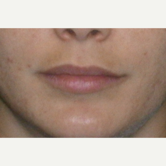 25-34 year old woman treated with Restylane before 3147076
