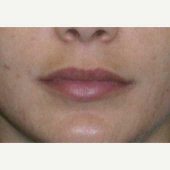 25-34 year old woman treated with Restylane after 3147076