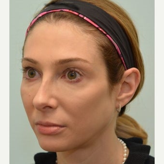 32 year old patient treated for mid face volume loss with Voluma after 1967391