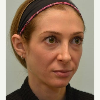 32 year old patient treated for mid face volume loss with Voluma 1967391