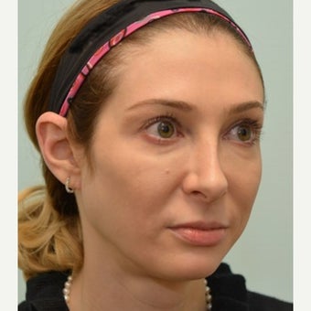 32 year old patient treated for mid face volume loss with Voluma 1967391
