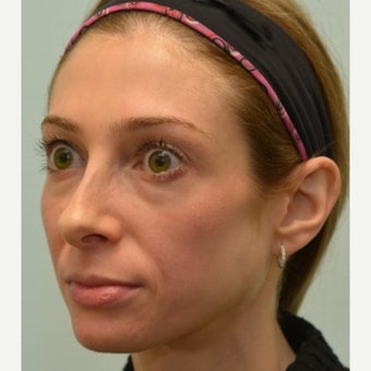 32 year old patient treated for mid face volume loss with Voluma before 1967391
