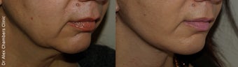 Mini Facelift Rejuvenates 42 Year Old Woman before 1307552