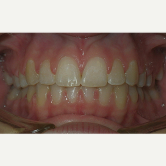 17 or under year old woman treated with Invisalign after 3658412