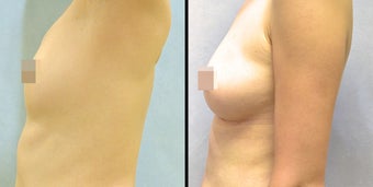 Fat Transfer before 649472