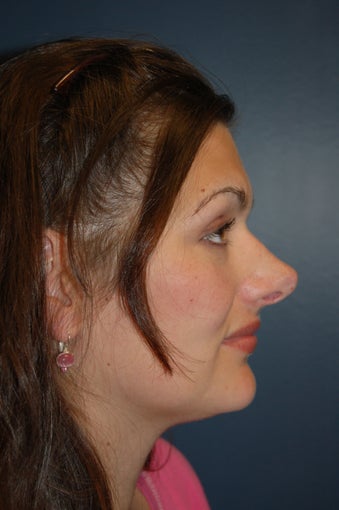 Revision Rhinoplasty before 925573