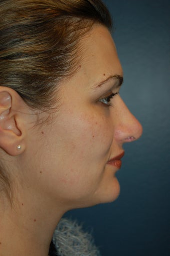 Revision Rhinoplasty after 925573