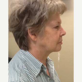 55-64 year old woman treated with Profound RF before 3530823