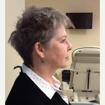55-64 year old woman treated with Profound RF after 3530823