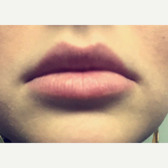 18-24 year old woman treated with Volbella after 3664574