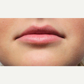18-24 year old woman treated with Volbella before 3664574