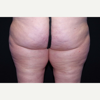 45-54 year old woman treated with Cellulaze before 3280722