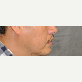 35-44 year old man treated with Lip Lift after 3175854