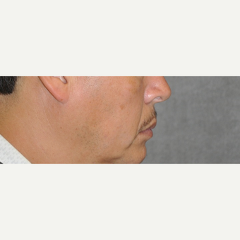 35-44 year old man treated with Lip Lift before 3175854