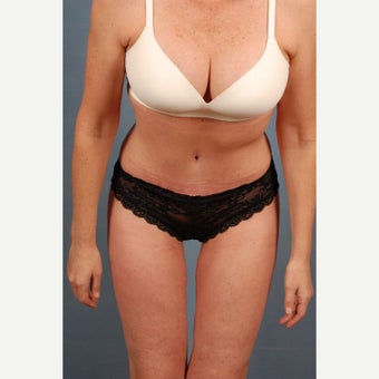 25-34 year old woman treated with Tummy Tuck 1648238