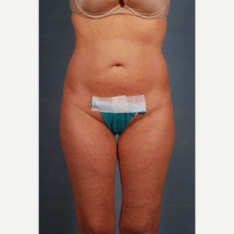 25-34 year old woman treated with Tummy Tuck before 1648238