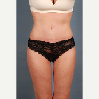 25-34 year old woman treated with Tummy Tuck after 1648238