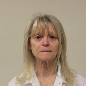 55-64 year old woman treated with Mini Lift before 3535826