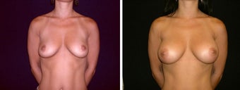 39 year old female, breast augmentation, San Francisco, California before 628345
