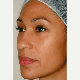35-44 year old woman treated with Rhinoplasty before 3406180